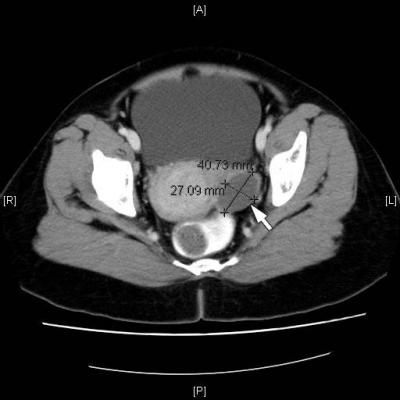 Figure.1: CT scan shows a cystic mass in the left adnexa (white arrow). 